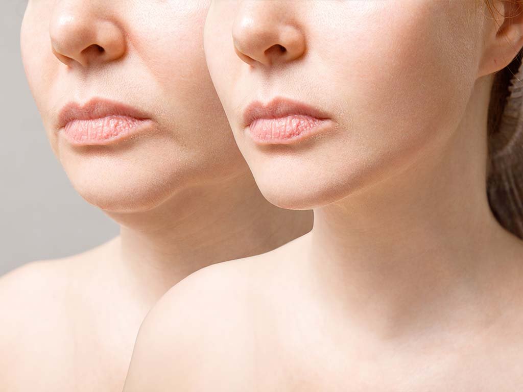 Wondering If Botox is Right for Your Face?