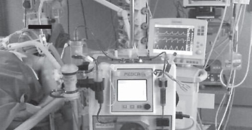 What Drives ECCO2R Devices Market Growth Through 2034?