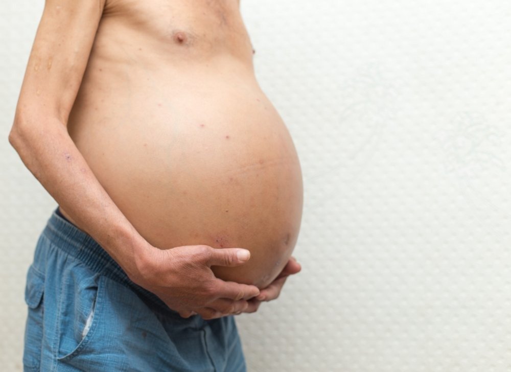 Understanding Ascites: Ayurvedic Causes, Diagnosis, and Treatment